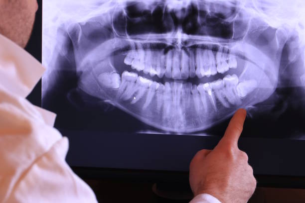 Best Emergency Dentist for Lost Fillings or Crowns in Rockfish, NC